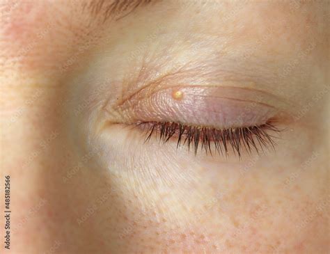 Fat on the eye of a young female woman, a small white wen on the upper ...