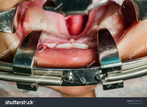 Cleft Lip Palate Surgery Operating Room Stock Photo 700478779 ...