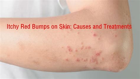 Raised Skin Bumps Pictures Causes And Treatment - vrogue.co