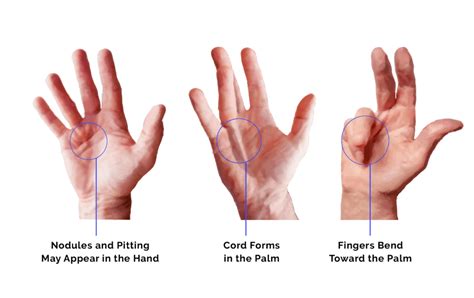 What is Dupuytren’s Contracture and How Can it be Treated? | Regenexx ...