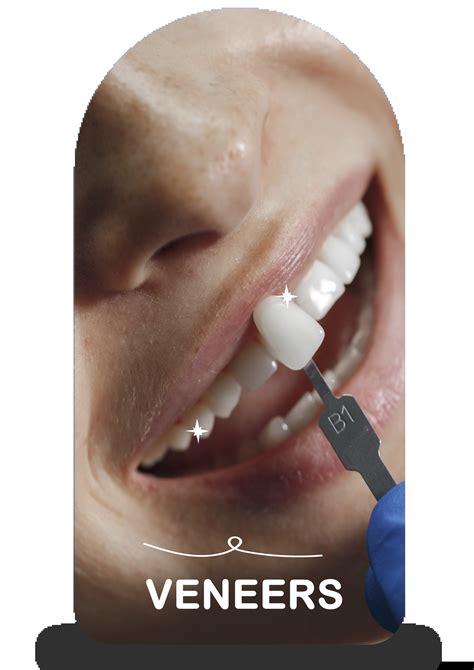 veneers