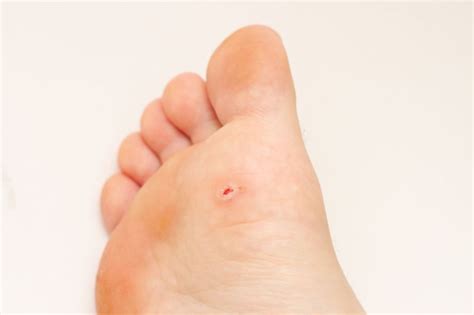 corn skin growth removal  dermatology clinic  hyderabad