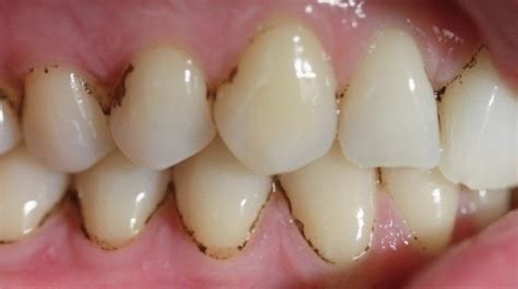 Unveiling Dental Dilemmas: 10 Common Causes of Black Spots on Teeth ...