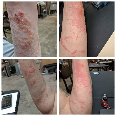 Poison Ivy Oil Burn