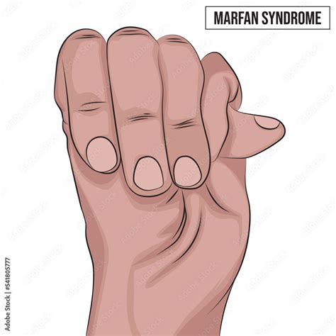 Marfan syndrome affects the heart, eyes, blood vessels, and bones ...