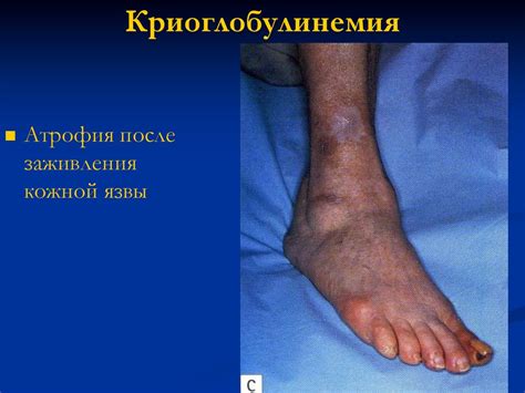 Системные васкулиты - презентация онлайн