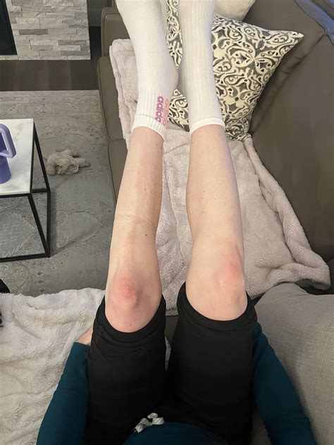 The amount of atrophy my left leg had after a cast for six weeks : r