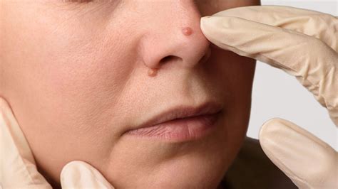 Nose Mole Removal | Solent Vascular Care