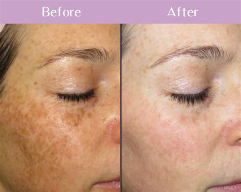 BBL Face Treatment - Eden Medical Clinic