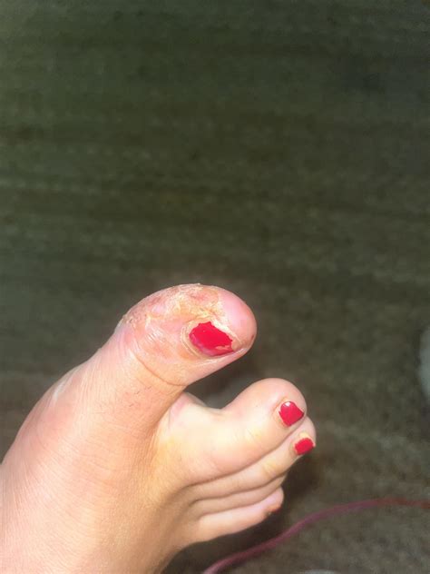 Plantar Wart Can’t seem to get fully rid of : r/Warts