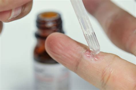 Wart Treatment - The Family Focus Medical Clinics