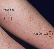 Idiopathic Thrombocytopenic Purpura Rash