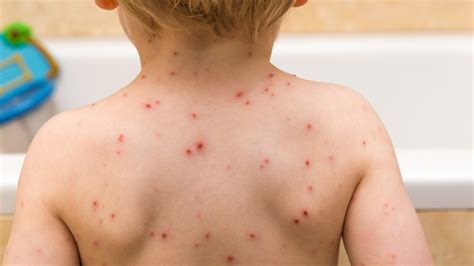 Shingles