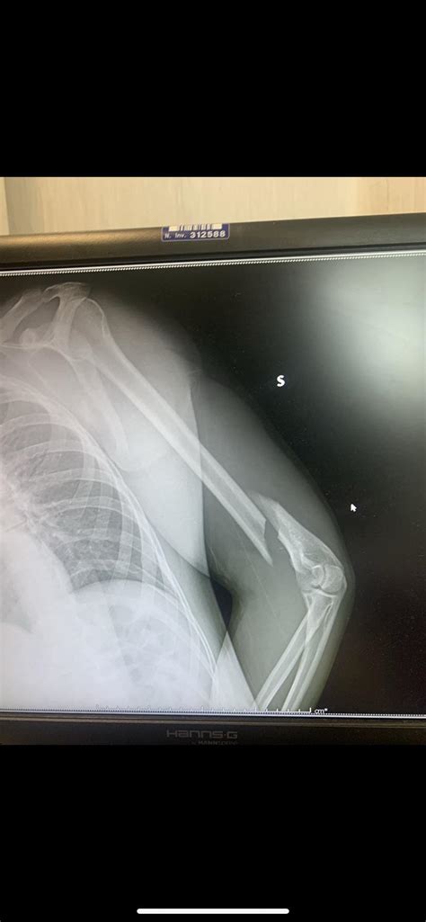 Broke my leg yesterday from skating. Spiral fracture. “Nice clean break ...