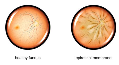 Macular Pucker | Retina Consultants of Orlando