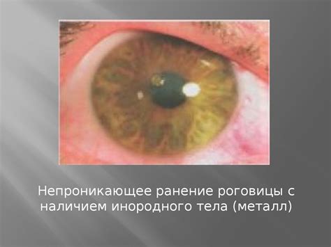 Травмы глаза - презентация онлайн