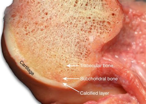 focal chondral injuries musculoskeletal key