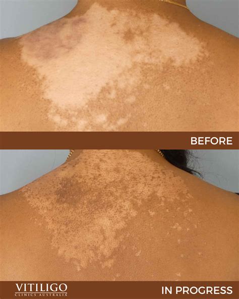 Vitiligo Before and After Treatment - Vitiligo Clinics Australia