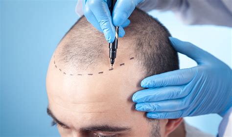 Hair Transplant for a Receding Hairline - Natural Hair Turkey