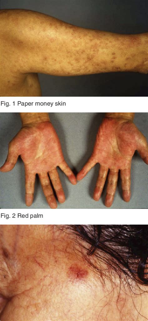 Figure 1 from Liver Diseases and Skin Lesions | Semantic Scholar