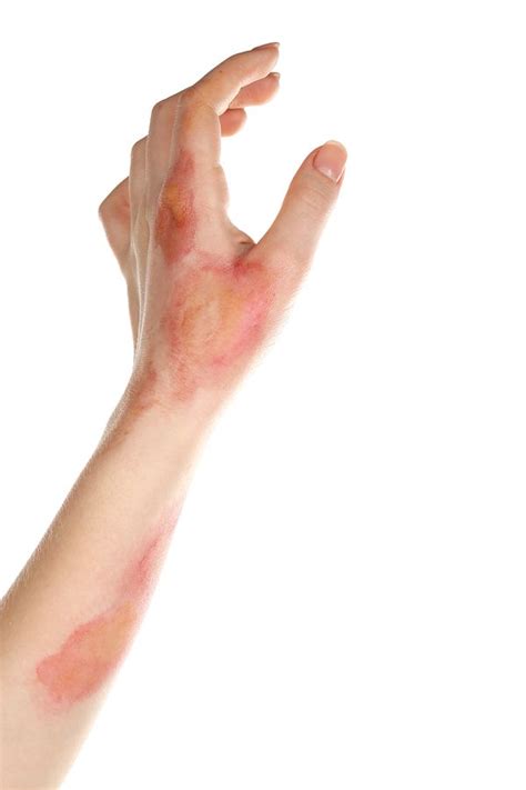 Pin by ASSH on Sprains, Fractures and Other Injuries | Hand injuries ...