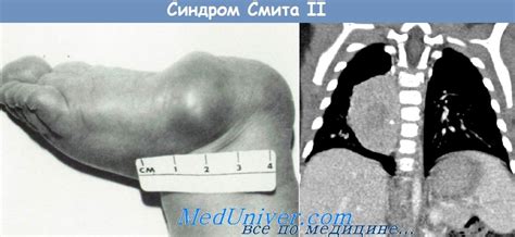 Синдром Смита II (Smith II) - синонимы, авторы, клиника