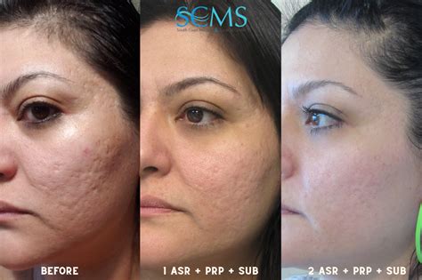 scar removal darwin  elizabeth ritchie blog