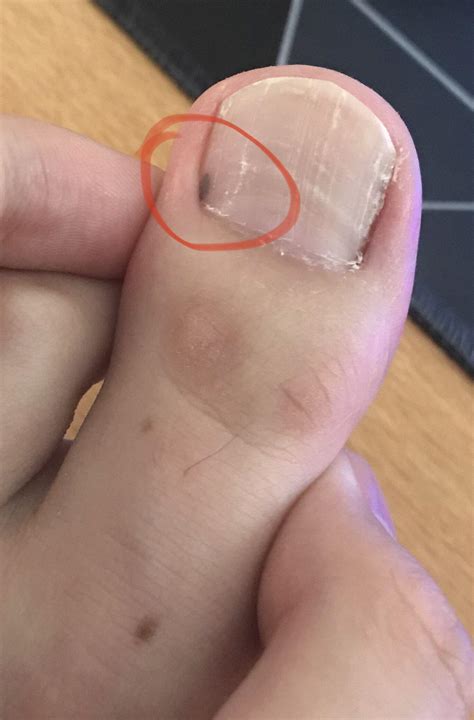 Black spot on corner of toenail? : DiagnoseMe