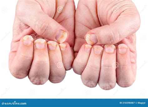 Fungal Nail Infection. Onychomycosis, Also Called Tinea Unguium Royalty ...