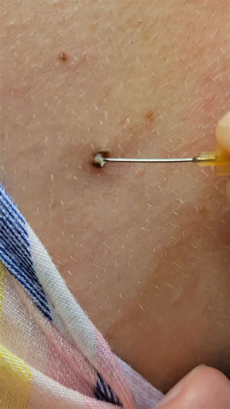 Coworker friend hasn't had her dilated pore emptied in a long time : r ...
