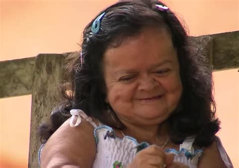sindrome de laron