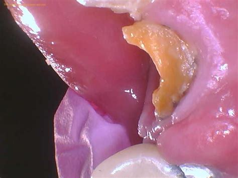 how to remove a broken tooth root at home