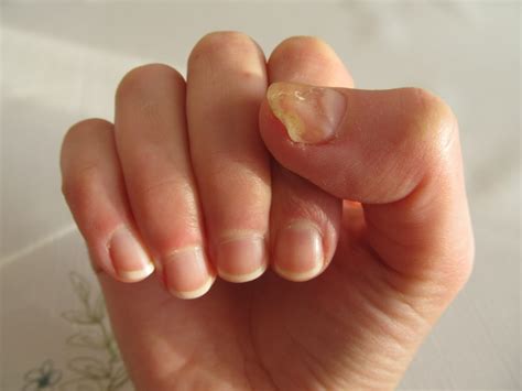 nail fungus anybodi