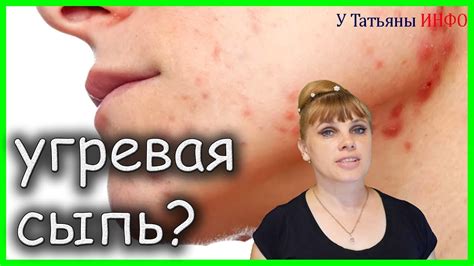 ЭФФЕКТИВНО!!! Как избавиться от АКНЕ (ПРЫЩЕЙ, УГРЕВОЙ СЫПИ) на лице ...