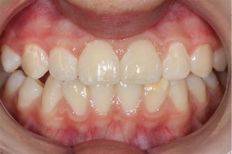 Before & After - Manly Orthodontics | Boutique Orthodontic Practice for ...
