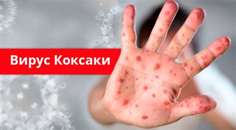 Коксаки инфекция: синдром „ръка – крак – уста“ > Sanitas.bg