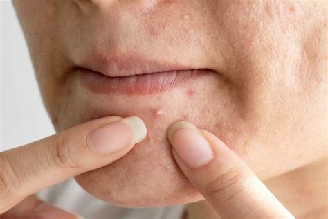 40 Yaşından Sonra Sivilce Neden Çıkar? - Güncel Oku