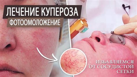 Фотоомоложение \ Лечение купероза на лице \ Чистка лица \ Аппаратная ...