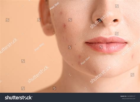 17,694 Blemishes on face Images, Stock Photos & Vectors | Shutterstock