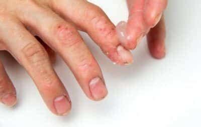 Alergia Entre Os Dedos Da Mão - Alergia nas mãos - Possíveis causas, tipos, sintomas e tratamentos
