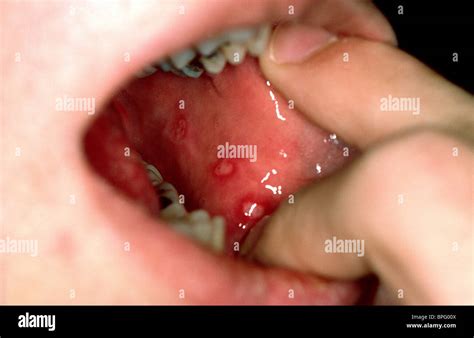 Cold Sore Inside Cheek