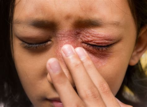 Periorbital Dermatitis Eyes