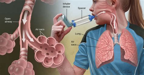 A Obstrução Dos Bronquíolos Impede Que O Oxigênio Atinja