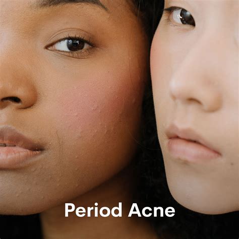 period acne period breakouts wuka