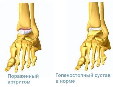 Артрит голеностопного сустава: симптомы, лечение