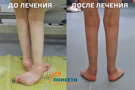 Лечение приобретенной косолапости у детей методом Понсети