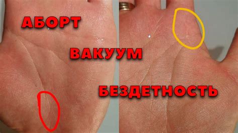 Аборт, вакуум и его последствия. Хиромантия - YouTube