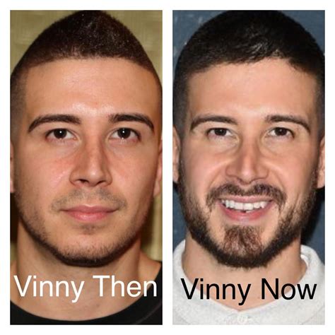 Did Vinny get a nose job? : r/jerseyshore