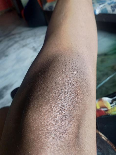 How To Remove Dry Skin On Knees at Mike Gloss blog