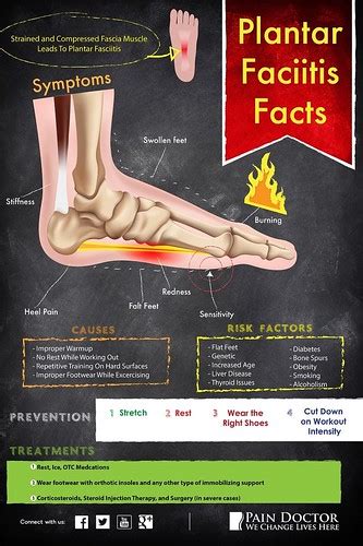 Plantar Fasciitis Infographic | Plantar Fasciitis Facts Stra… | Flickr